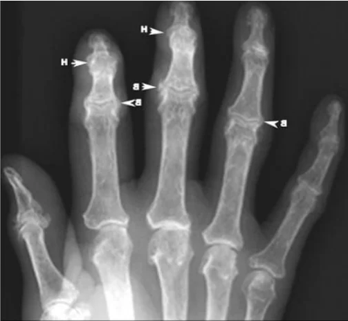 Osteophytes in osteoarthritis of the finger joints on an x-ray