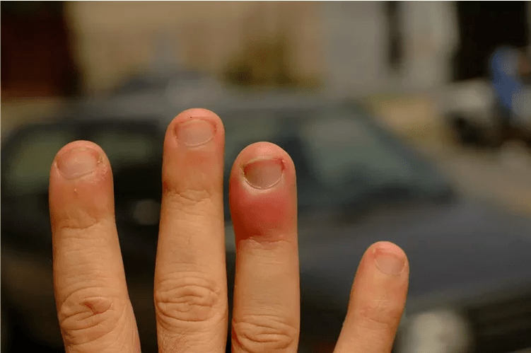 Panaritium periungual, causing pain in the joints of the fingers