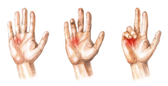 Stages of Dupuytren's contracture - the inability to straighten the fingers