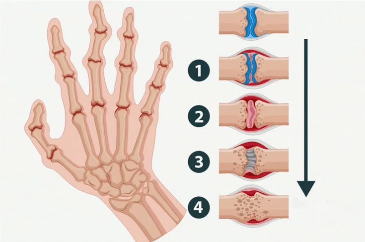 Stages of rheumatoid arthritis affecting the joints of the fingers