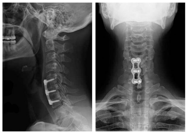 Photo after treatment of vertebrae