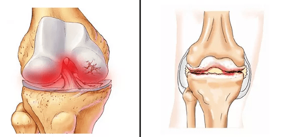 Comparison of arthritis