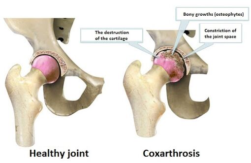 Healthy union affected by the union of coxartrosis