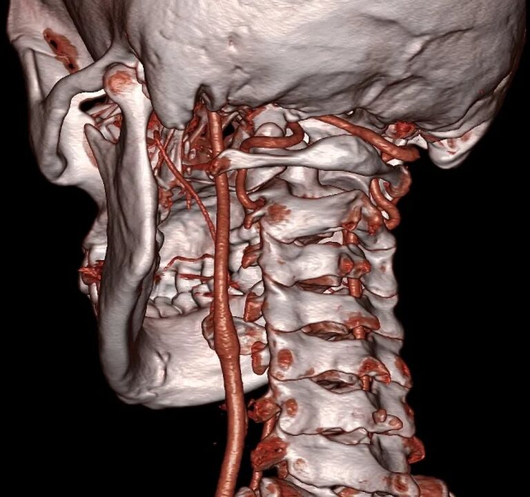 compressed artery with cervical osteochondrosis