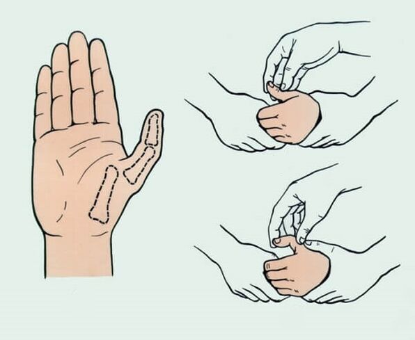 Reduction of a dislocated finger, necessary to eliminate joint pain