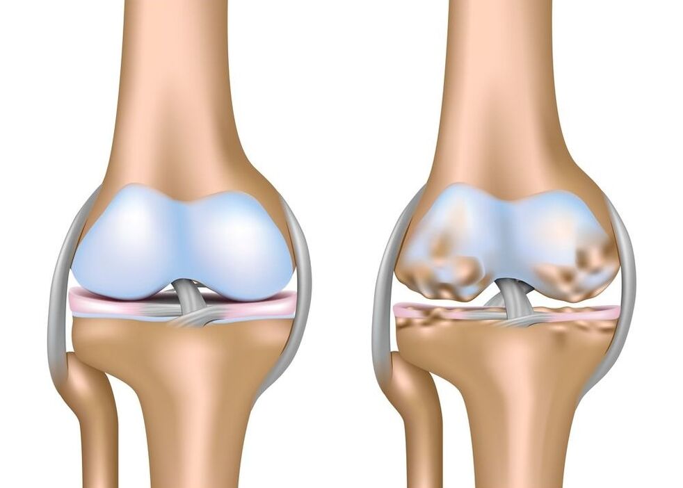 worsening of joint arthrosis