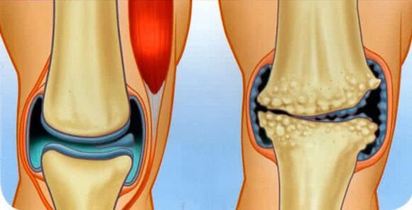 healthy joint and arthrosis of the ankle