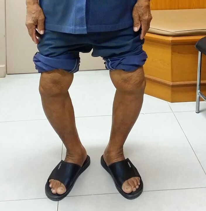 osteoarthritis deformed knee joints