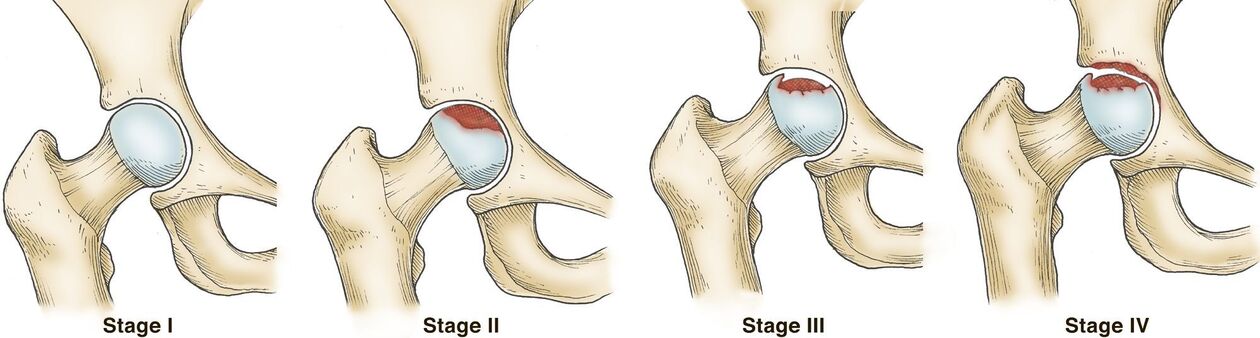 Degrees of hip arthrosis