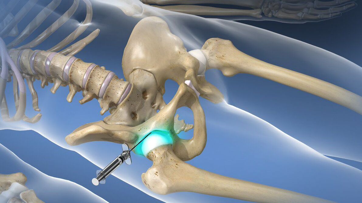 Intra-articular blockade for severe pain associated with hip osteoarthritis