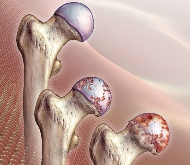 Osteoarthritis of the hip joint to varying degrees