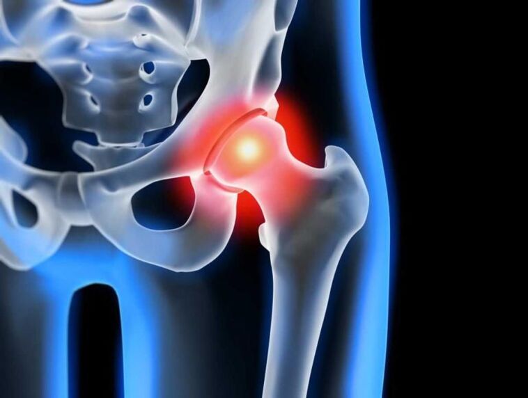 Osteoarthritis of the hip