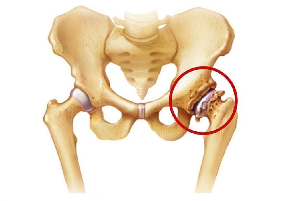 Thigh joint affected by osteoarthritis