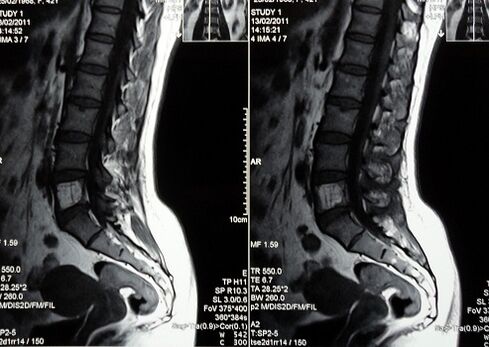 MRI of the lumbosacral spine to diagnose low back pain